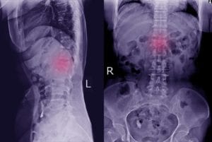 X-ray result of a person with a spinal injury