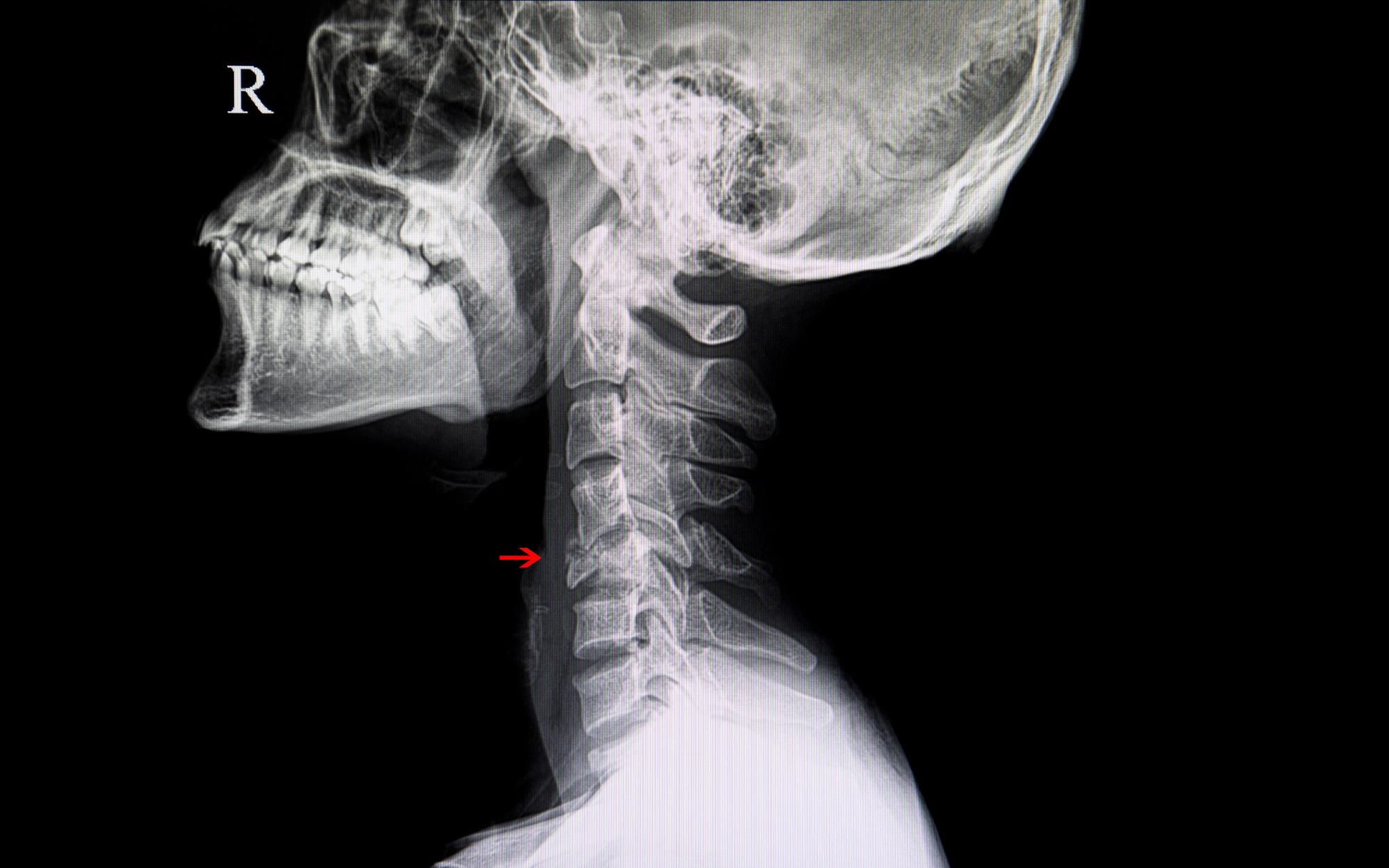 Xray result of a person with a neck injury