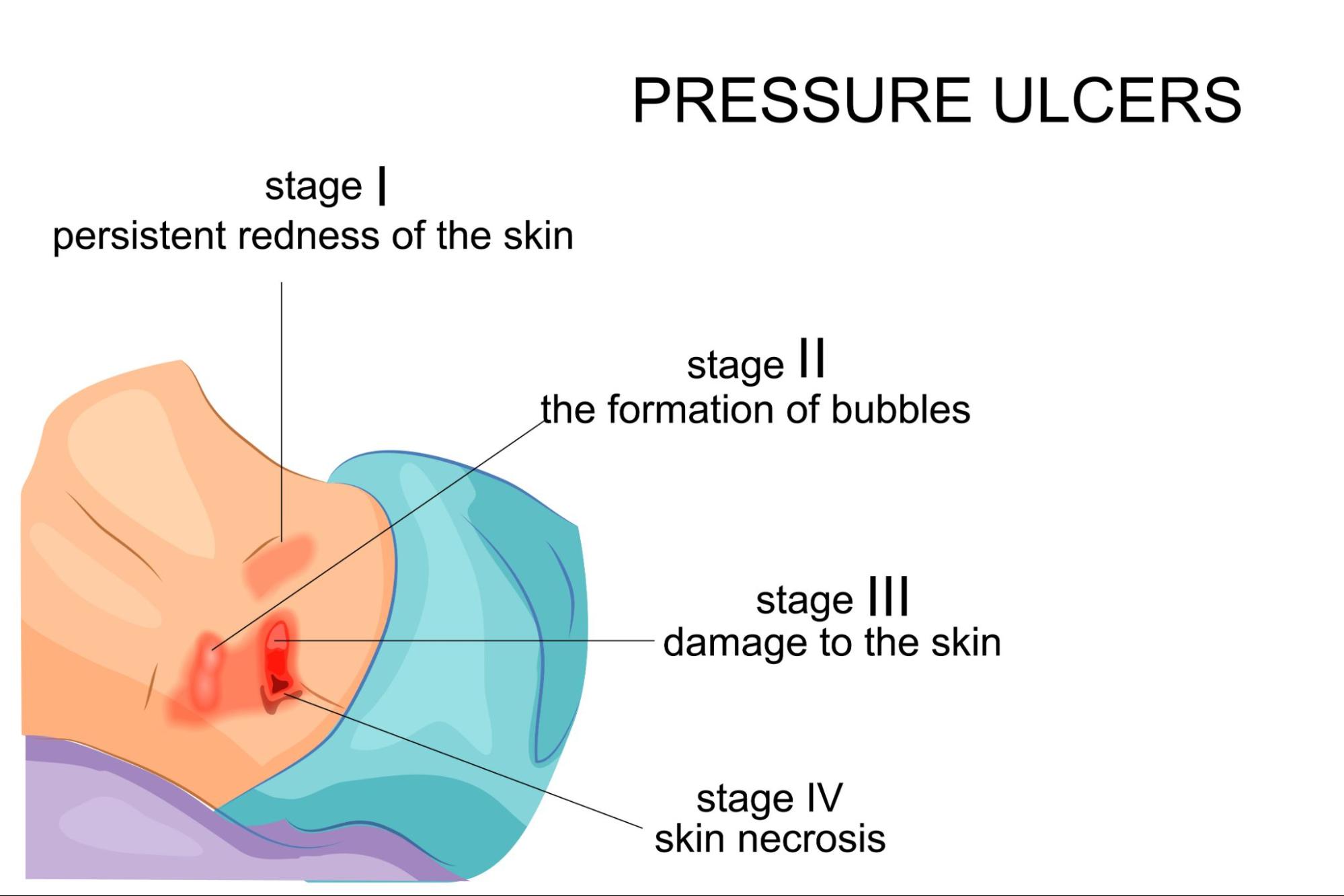 Stages of pressure ulcers