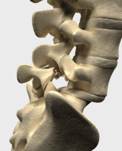 Spondylolisthesis Car Accident Settlement